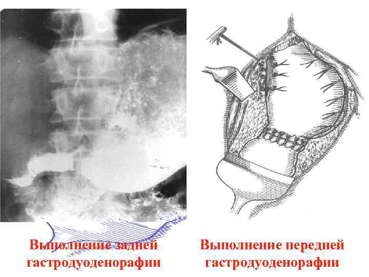 Выполнение задней гастродуоденорафии Выполнение передней гастродуоденорафии 