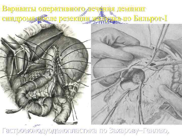 Варианты оперативного лечения демпинг синдрома после резекции желудка по Бильрот-I Гастроеюнодуоденопластика по Захарову–Генлею, 