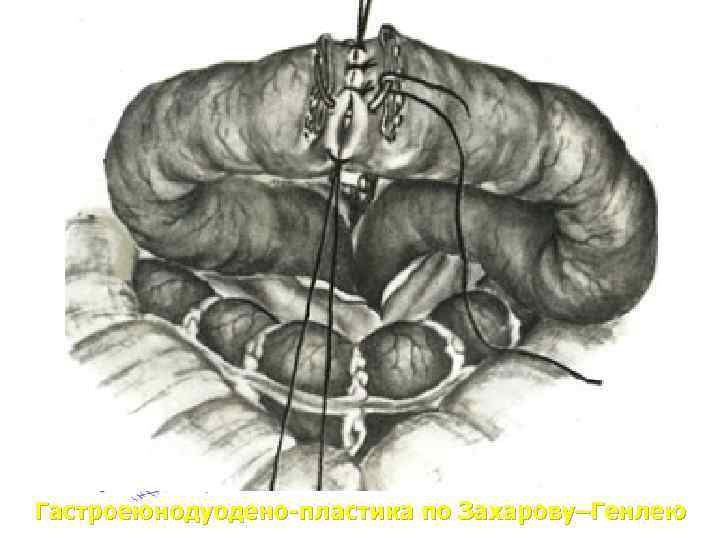 Гастроеюнодуодено-пластика по Захарову–Генлею 