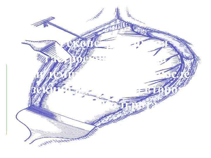  Реконструктивная гастроеюнопластика при демпинг синдроме после резекции желудка по второму способу Бильрота 