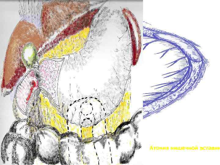  Атония кишечной вставки 