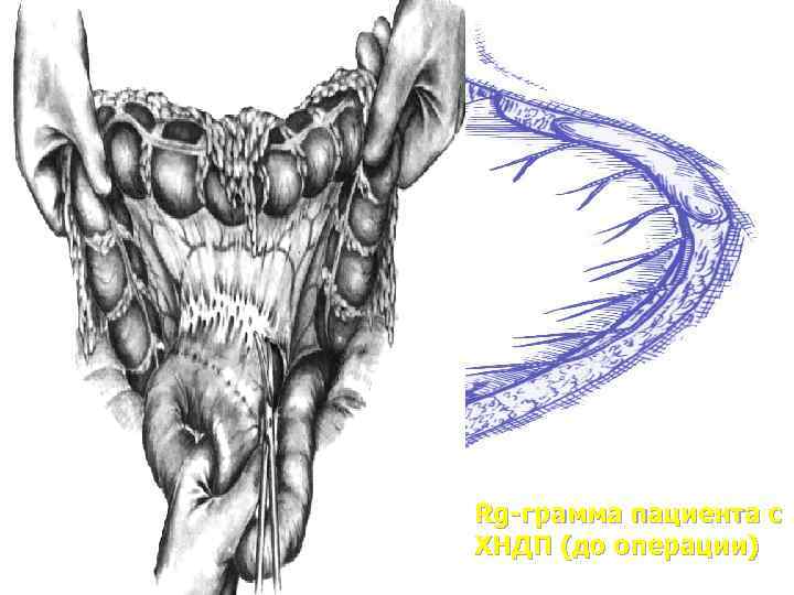 Rg-грамма пациента с ХНДП (до операции) 