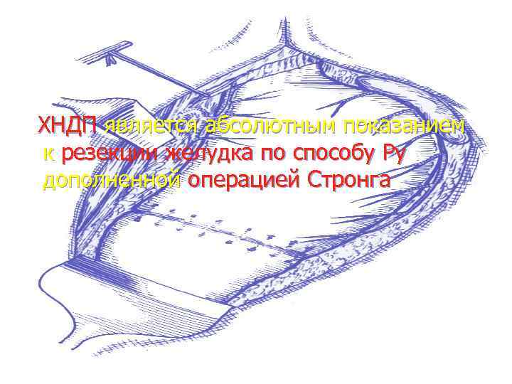  ХНДП является абсолютным показанием к резекции желудка по способу Ру дополненной операцией Стронга