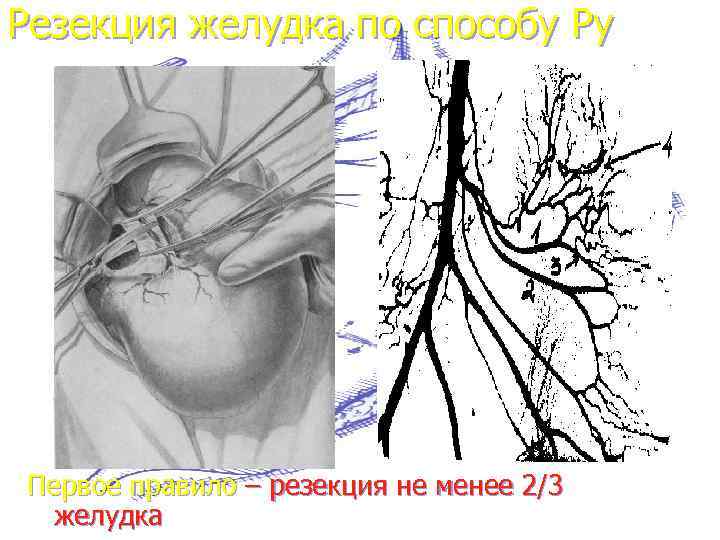 Резекция желудка по способу Ру Первое правило – резекция не менее 2/3 желудка 
