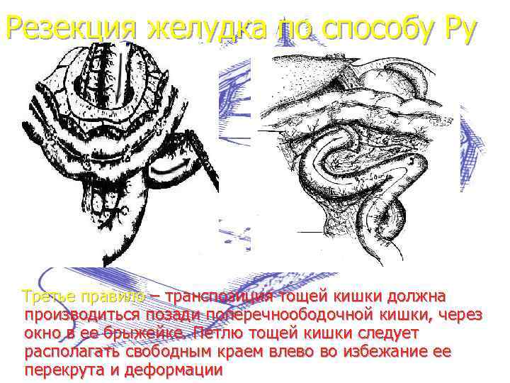 Резекция желудка по способу Ру Третье правило – транспозиция тощей кишки должна производиться позади