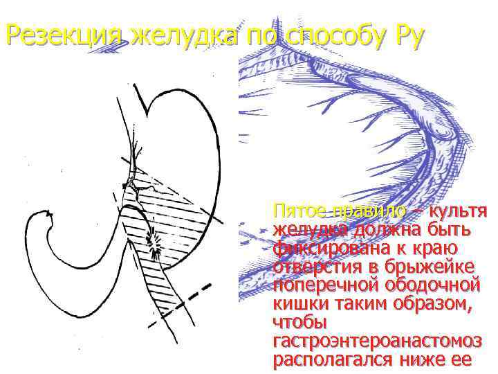 Резекция желудка по бальфуру схема