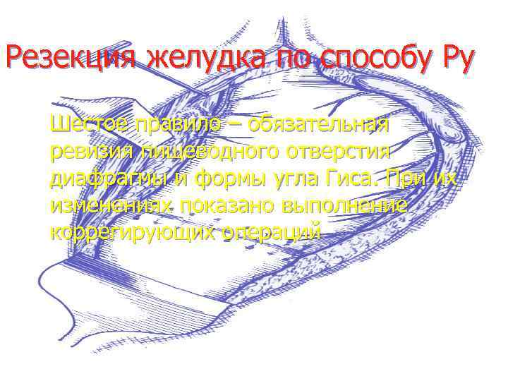 Резекция желудка по способу Ру Шестое правило – обязательная ревизия пищеводного отверстия диафрагмы и