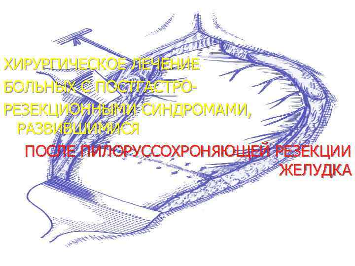 ХИРУРГИЧЕСКОЕ ЛЕЧЕНИЕ БОЛЬНЫХ С ПОСТГАСТРОРЕЗЕКЦИОННЫМИ СИНДРОМАМИ, РАЗВИВШИМИСЯ ПОСЛЕ ПИЛОРУССОХРОНЯЮЩЕЙ РЕЗЕКЦИИ ЖЕЛУДКА 