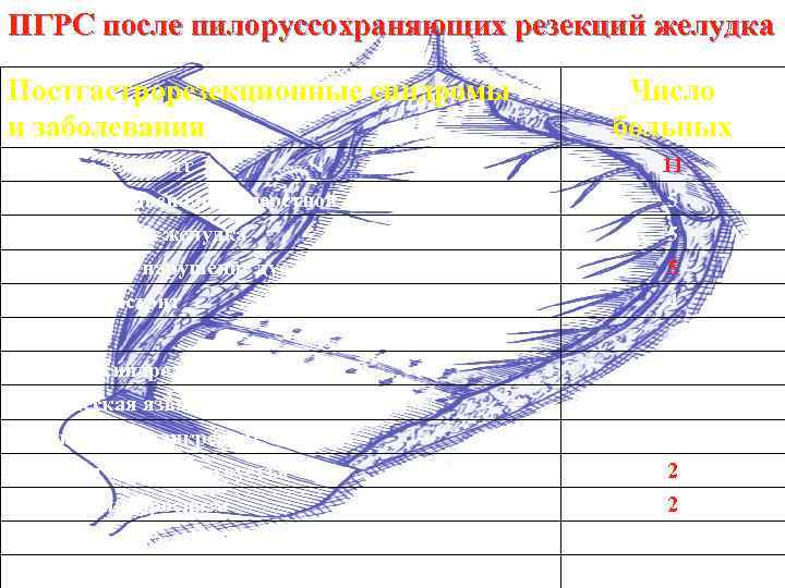 ПГРС после пилоруссохраняющих резекций желудка Постгастрорезекционные синдромы и заболевания Число больных Рефлюкс-эзофагит 11 Дивертикул