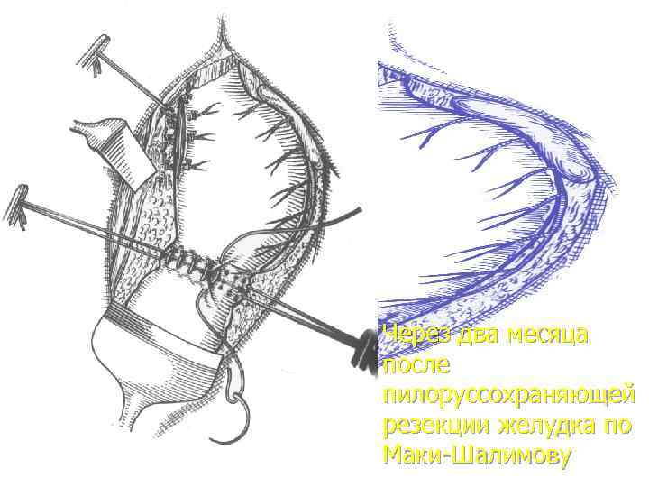 Через два месяца после пилоруссохраняющей резекции желудка по Маки-Шалимову 