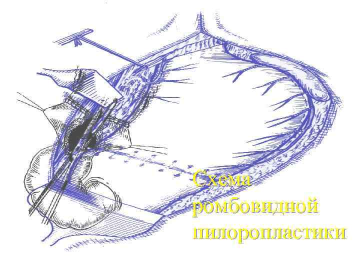 Схема ромбовидной пилоропластики 
