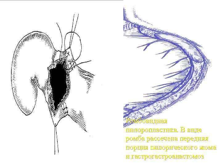 Ромбовидная пилоропластика. В виде ромба рассечена передняя порция пилорического жома и гастроанастомоз 