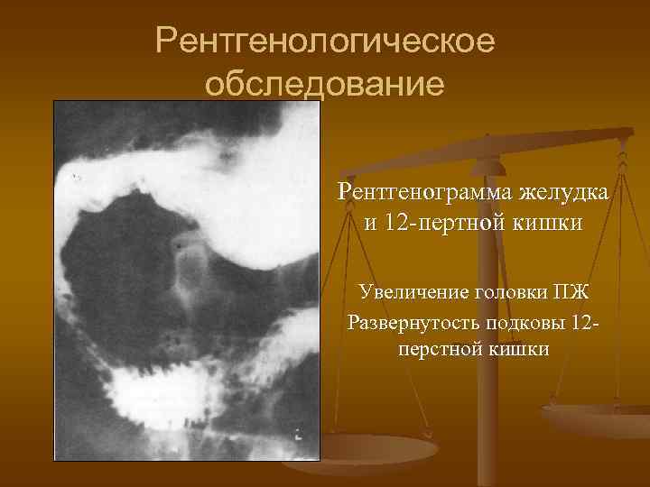 Рентгенологическое обследование Рентгенограмма желудка и 12 -пертной кишки Увеличение головки ПЖ Развернутость подковы 12