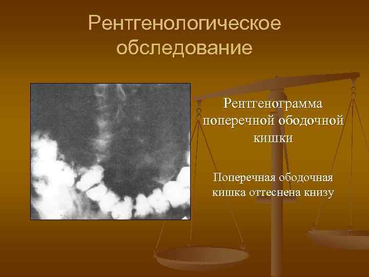 Рентгенологическое обследование Рентгенограмма поперечной ободочной кишки Поперечная ободочная кишка оттеснена книзу 