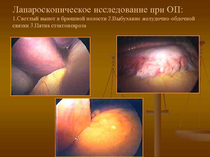 Лапароскопическое исследование при ОП: 1. Светлый выпот в брюшной полости 2. Выбухание желудочно-обдочной связки