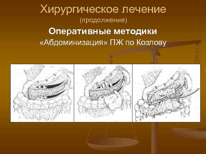 Хирургическое лечение (продолжение) Оперативные методики «Абдоминизация» ПЖ по Козлову 