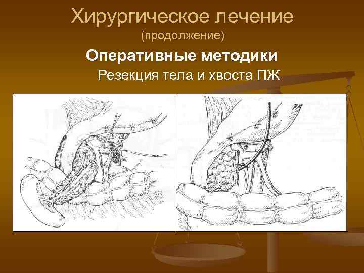 Хирургическое лечение (продолжение) Оперативные методики Резекция тела и хвоста ПЖ 