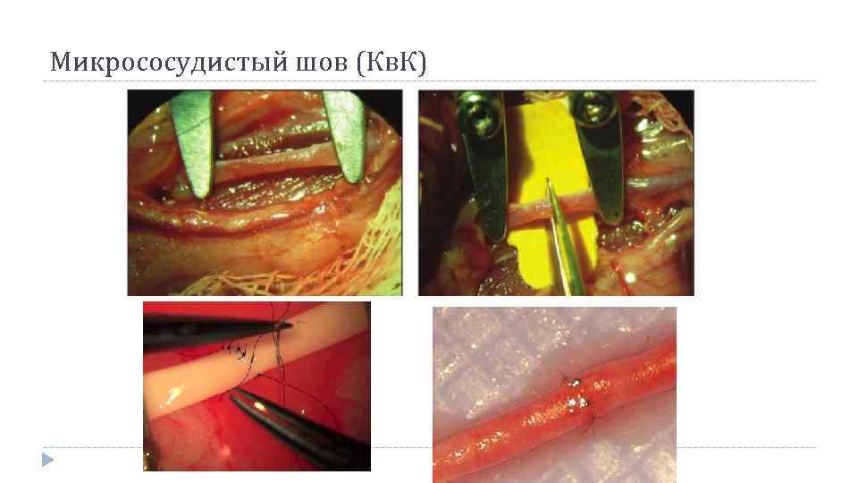 Микрососудистый шов (Кв. К) 