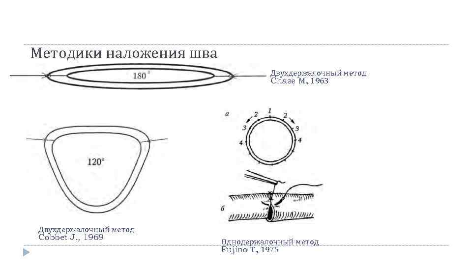 Методики наложения шва Двухдержалочный метод Chase М. , 1963 Двухдержалочный метод Cobbet J. ,