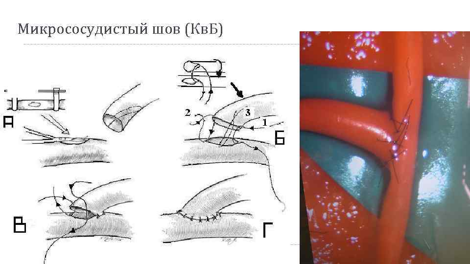 Микрососудистый шов (Кв. Б) 