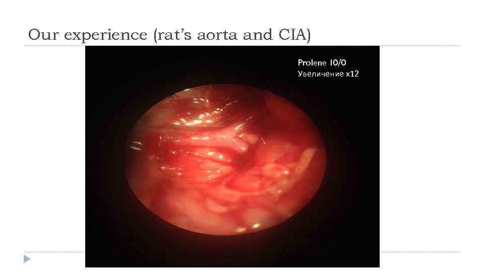 Our experience (rat’s aorta and CIA) Prolene 10/0 Увеличение х12 Aorta 