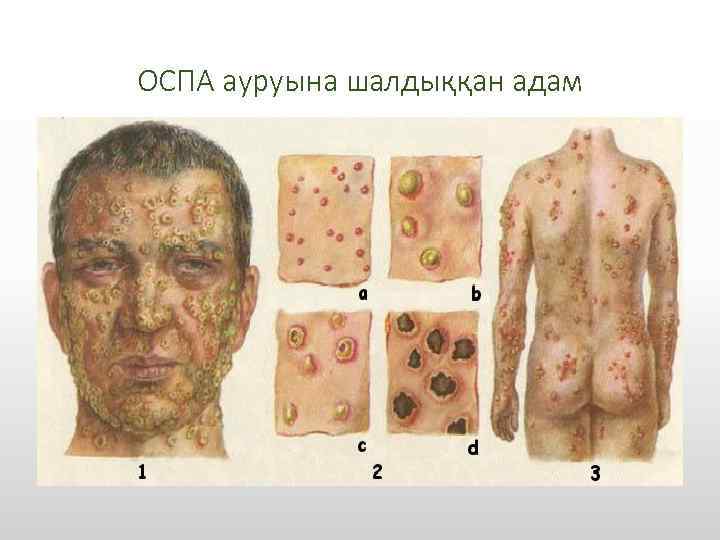 ОСПА ауруына шалдыққан адам 