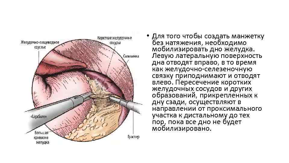  • Для того чтобы создать манжетку без натяжения, необходимо мобилизировать дно желудка. Левую