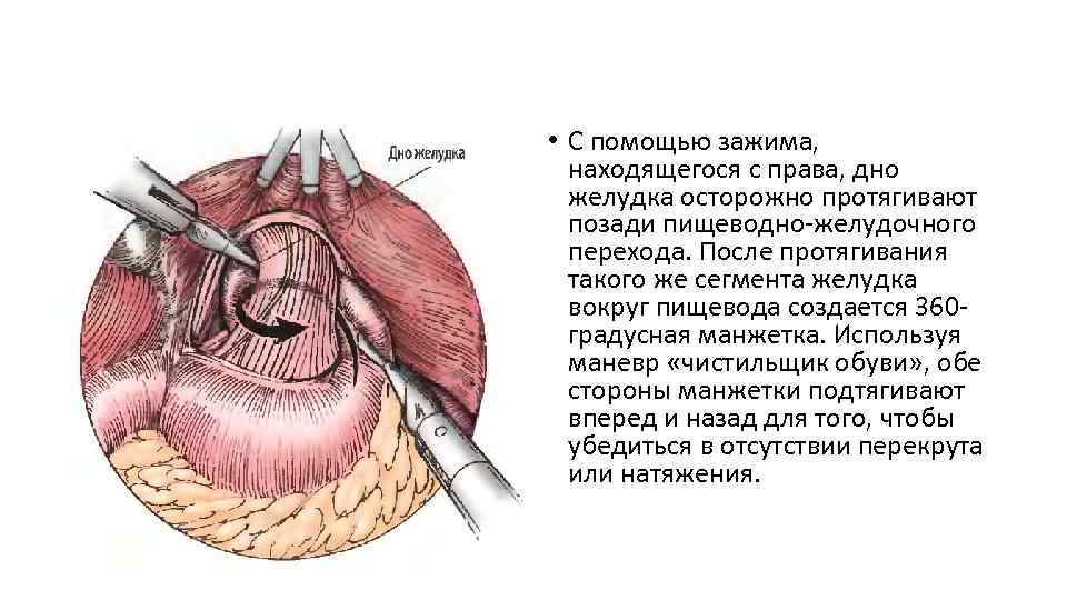  • С помощью зажима, находящегося с права, дно желудка осторожно протягивают позади пищеводно-желудочного
