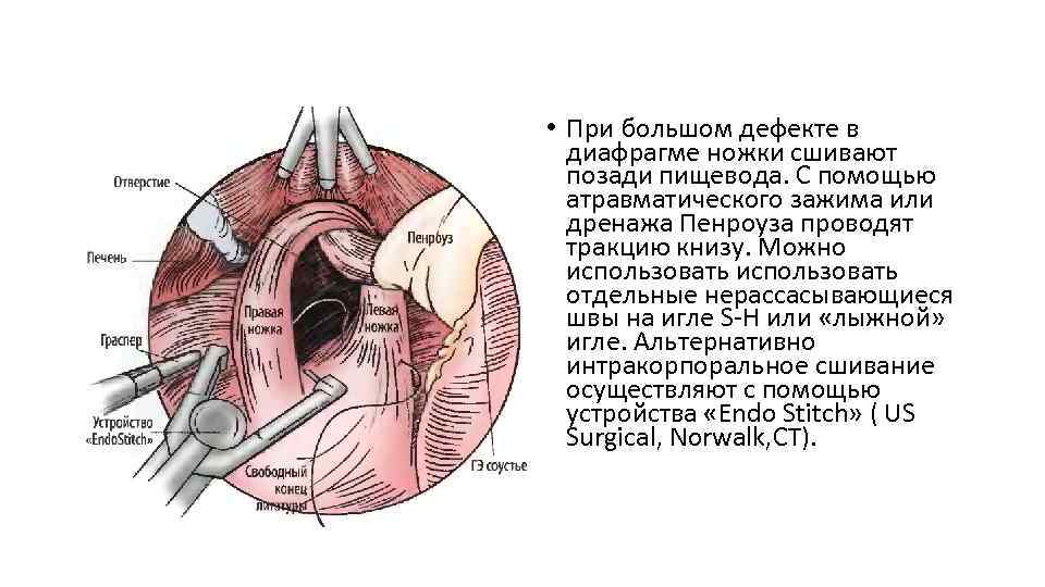  • При большом дефекте в диафрагме ножки сшивают позади пищевода. С помощью атравматического