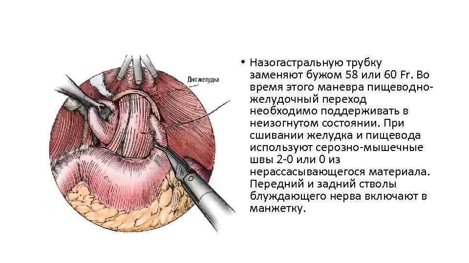  • Назогастральную трубку заменяют бужом 58 или 60 Fr. Во время этого маневра