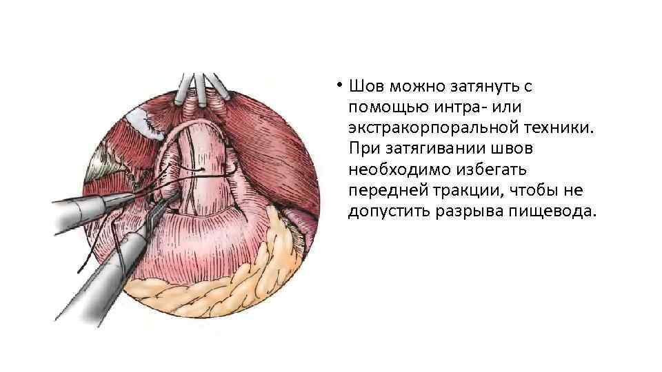  • Шов можно затянуть с помощью интра- или экстракорпоральной техники. При затягивании швов