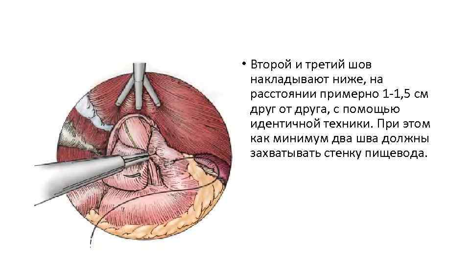  • Второй и третий шов накладывают ниже, на расстоянии примерно 1 -1, 5