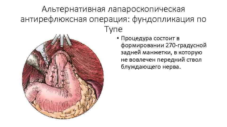 Альтернативная лапароскопическая антирефлюксная операция: фундопликация по Тупе • Процедура состоит в формировании 270 -градусной
