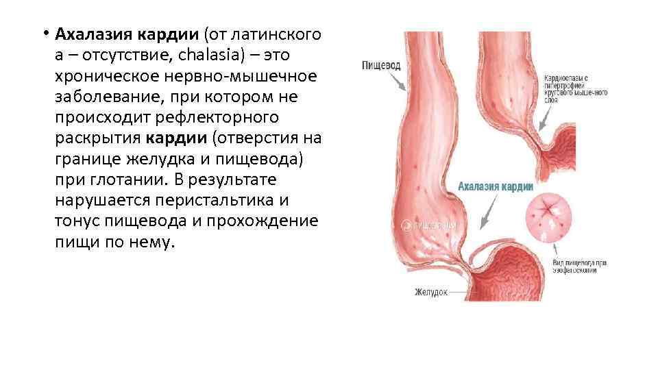  • Ахалазия кардии (от латинского а – отсутствие, chalasia) – это хроническое нервно-мышечное