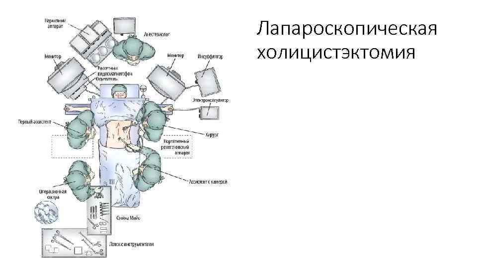 Лапароскопическая холицистэктомия 