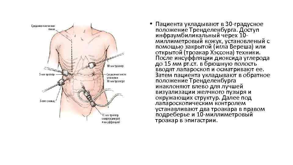  • Пациента укладывают в 30 -градусное положение Тренделенбурга. Доступ инфраумбиликальный черех 10 миллиметровый