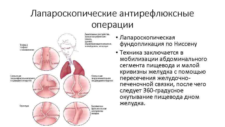 Лапароскопические антирефлюксные операции • Лапароскопическая фундопликация по Ниссену • Техника заключается в мобилизации абдоминального