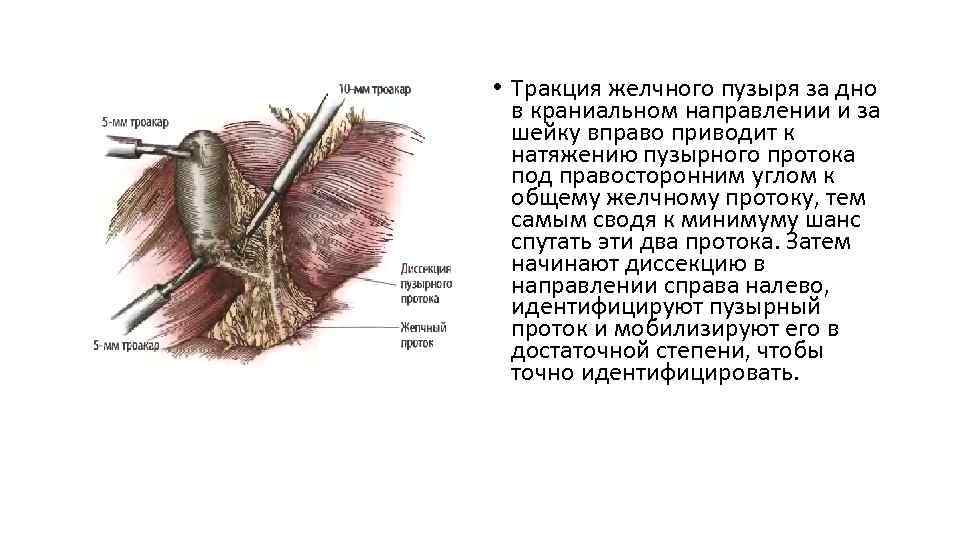  • Тракция желчного пузыря за дно в краниальном направлении и за шейку вправо