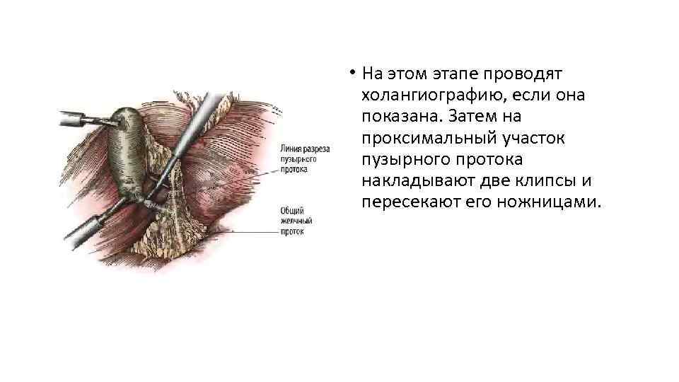  • На этом этапе проводят холангиографию, если она показана. Затем на проксимальный участок