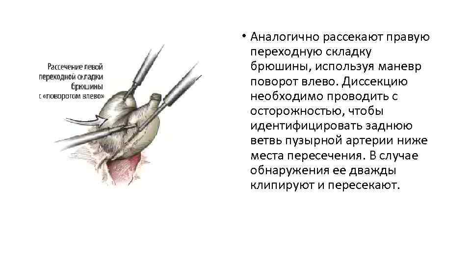  • Аналогично рассекают правую переходную складку брюшины, используя маневр поворот влево. Диссекцию необходимо