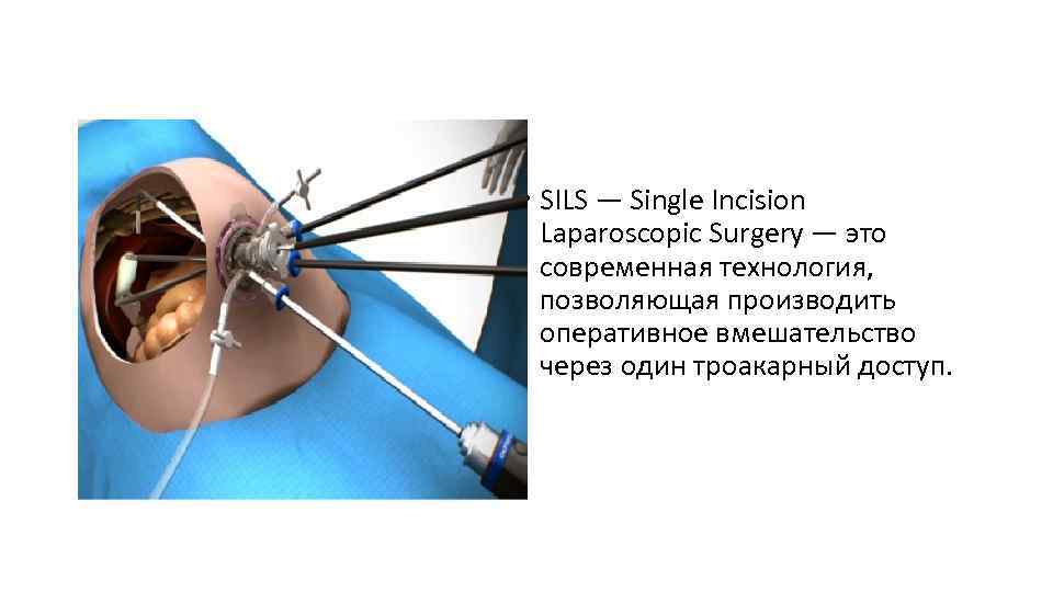  • SILS — Single Incision Laparoscopic Surgery — это современная технология, позволяющая производить