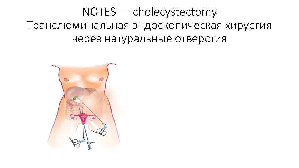 NOTES — cholecystectomy Транслюминальная эндоскопическая хирургия через натуральные отверстия 