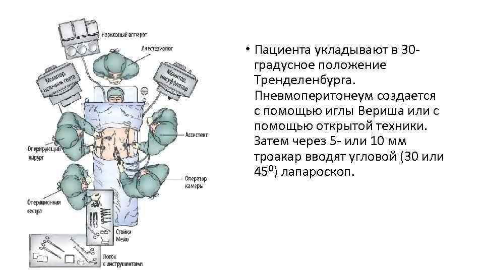  • Пациента укладывают в 30 градусное положение Тренделенбурга. Пневмоперитонеум создается с помощью иглы
