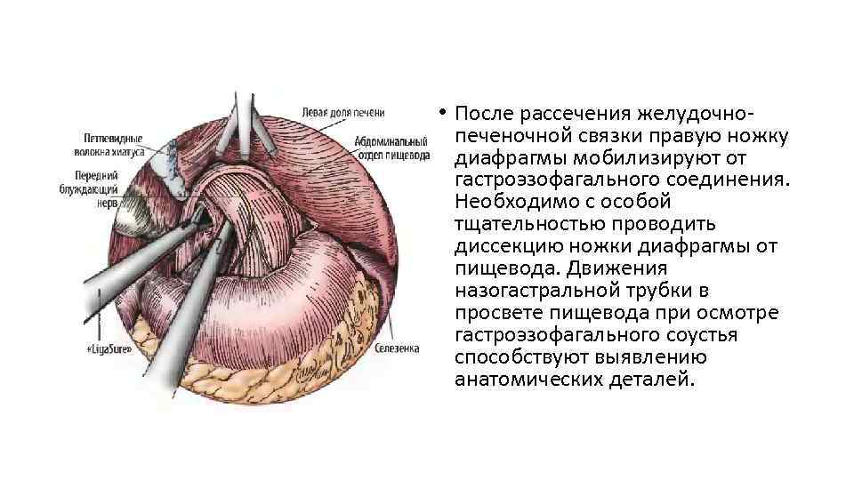  • После рассечения желудочнопеченочной связки правую ножку диафрагмы мобилизируют от гастроэзофагального соединения. Необходимо