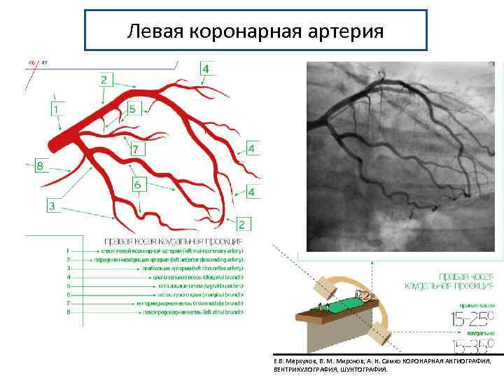 Левая коронарная артерия Е. В. Меркулов, В. М. Миронов, А. Н. Самко КОРОНАРНАЯ АНГИОГРАФИЯ,