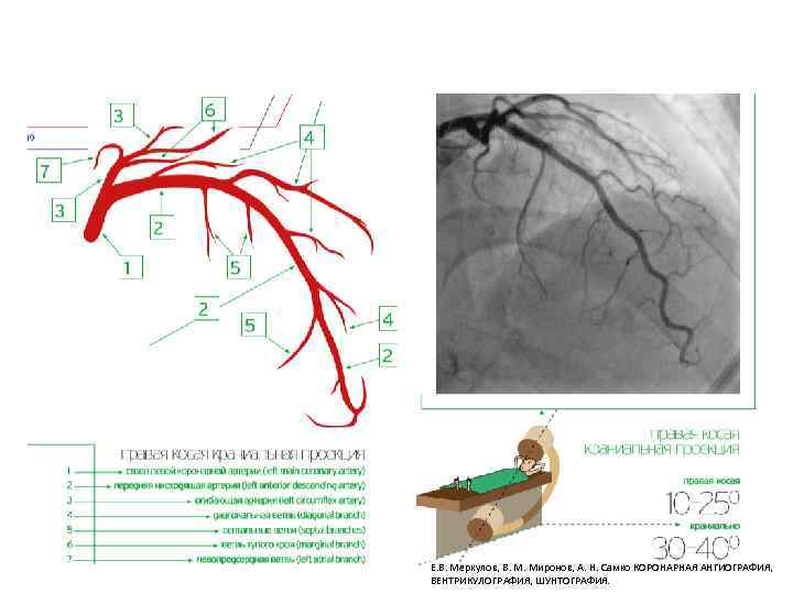 Е. В. Меркулов, В. М. Миронов, А. Н. Самко КОРОНАРНАЯ АНГИОГРАФИЯ, ВЕНТРИКУЛОГРАФИЯ, ШУНТОГРАФИЯ. 