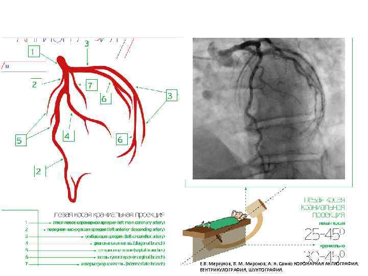 Е. В. Меркулов, В. М. Миронов, А. Н. Самко КОРОНАРНАЯ АНГИОГРАФИЯ, ВЕНТРИКУЛОГРАФИЯ, ШУНТОГРАФИЯ. 