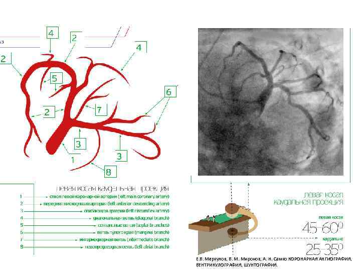 Е. В. Меркулов, В. М. Миронов, А. Н. Самко КОРОНАРНАЯ АНГИОГРАФИЯ, ВЕНТРИКУЛОГРАФИЯ, ШУНТОГРАФИЯ. 