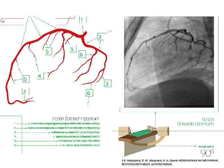 Е. В. Меркулов, В. М. Миронов, А. Н. Самко КОРОНАРНАЯ АНГИОГРАФИЯ, ВЕНТРИКУЛОГРАФИЯ, ШУНТОГРАФИЯ. 
