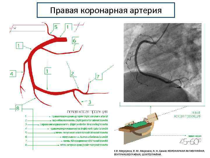 Правая коронарная артерия Е. В. Меркулов, В. М. Миронов, А. Н. Самко КОРОНАРНАЯ АНГИОГРАФИЯ,